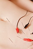 Electroacupuncture fertility treatment