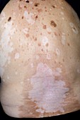 Vitiligo and seborrheic warts