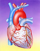 Coronary atherosclerosis,artwork