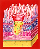 Intestinal ulcer,artwork