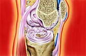Gout in knee joint,artwork