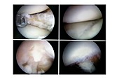 Torn knee cartilage arthroscopy