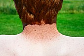 Freckles and red hair,sunburn