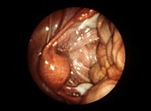 Fallopian tube,laparoscopic image