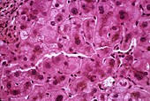Haemochromatosis of the liver,micrograph