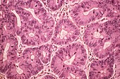 Cancer intestinal polyp,light micrograph