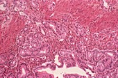 Gallbladder cancer,light micrograph