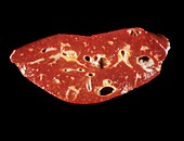 Polycystic liver
