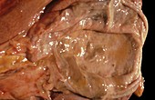 Inflamed gallbladder