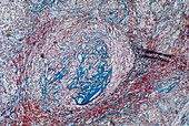 Intestinal cancer,light micrograph