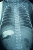 Situs inversus in a child,X-ray