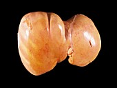 Fatty liver,light micrograph