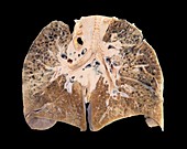 Primary lung cancer,clinical specimen