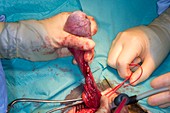 Testicular cancer surgery