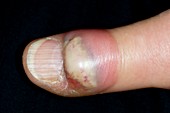 Thumb abscess