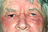 Eczema around the eye