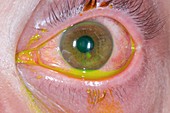 Corneal abrasion with staining