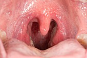 Throat in glandular fever