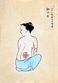Tumour on back,19th-century Japan