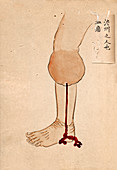 Growth on leg,19th-century Japan