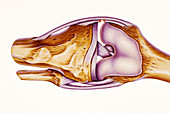 Sprained knee,illustration