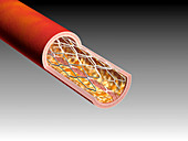 Illustration of an arterial stent