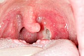 Infected tonsil