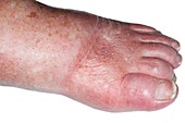 Foot oedema