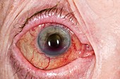 Eye after treatment for glaucoma