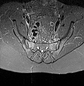 Sacroiliitis,MRI scan