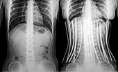 Woman wearing a corset x-ray