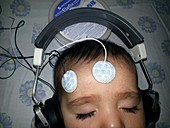 Brainstem evoked response audiometry