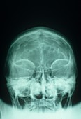 Brain tumour,X-ray