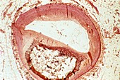 Atherosclerosis,light micrograph