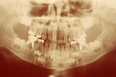 Cavities in a child's milk teeth