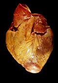 Cardiac amyloidosis