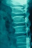 Lumbar spinal stenosis,X-ray