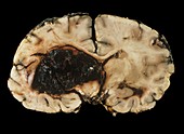 Brain haemorrhage