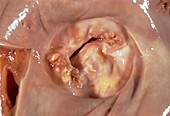 Narrowed heart valve