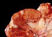Polyarteritis nodosa in a kidney