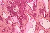 Glomus tumour,light micrograph