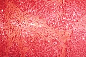 Liver in kwashiorkor,light micrograph