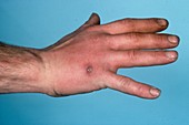 Inflamed lymph vessels in the hand