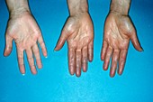 Acrocyanosis of the hands