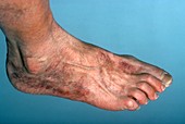 Ischemia of the foot