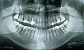 Dental X-ray showing fillings