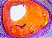 Atherosclerosis,light micrograph