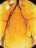 Femoral arteritis,X-ray