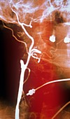 Occluded carotid artery,X-ray