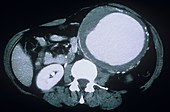 Aortic aneurysm,CT scan